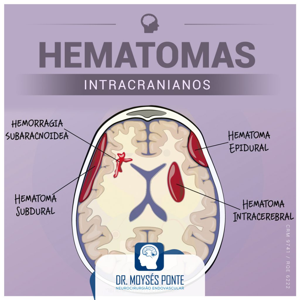 Hematomas Intracranianos - Dr. Moysés Ponte