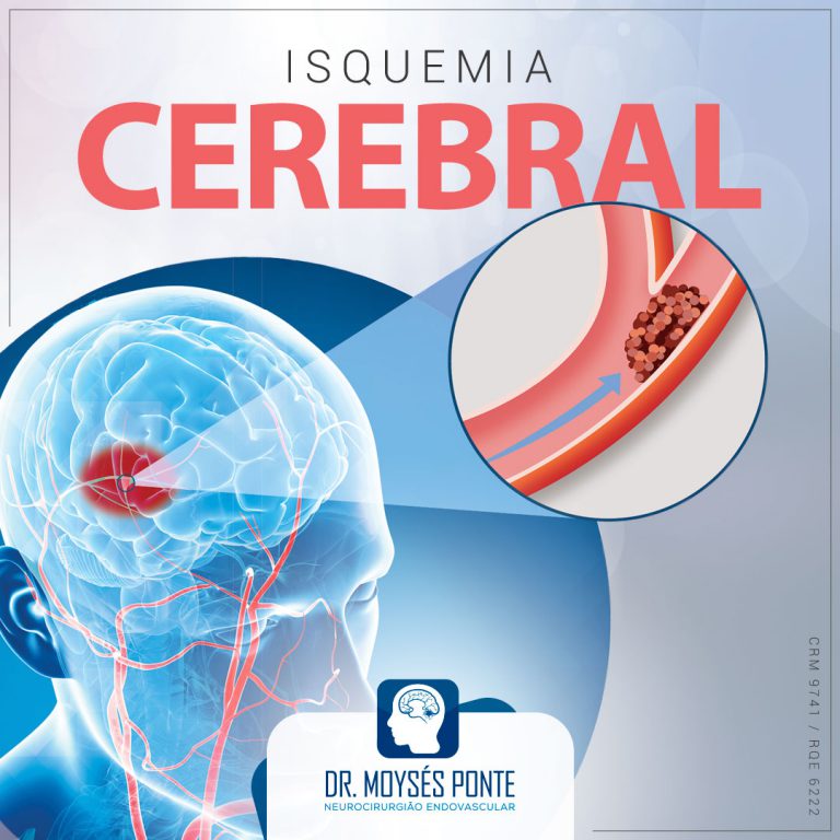 Isquemia Cerebral tem tratamento? - Dr. Moysés Ponte